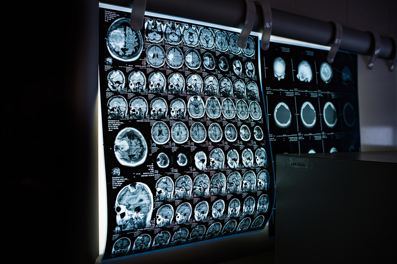Reshape MS Care: Le competenze specialistiche dell’infermiere esperto nella gestione del paziente con Sclerosi Multipla